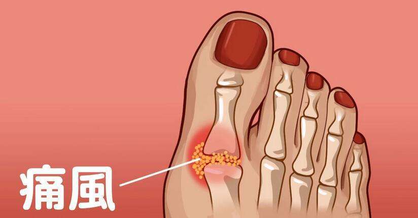 痛风的形成如何科学的方式及特效药
