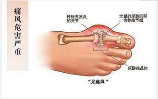 痛风的形成如何科学的方式及特效药