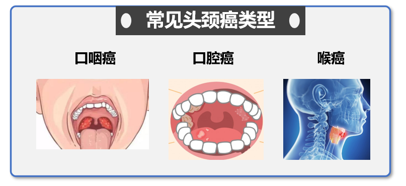 帕博利珠单抗(K药)获批一线治疗头颈部鳞癌！口腔癌、咽癌、喉癌免疫治疗来啦