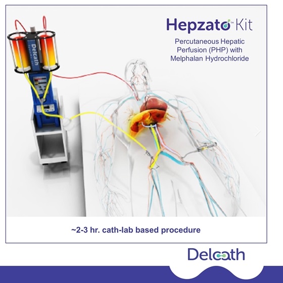 首款|HEPZATO(美法仑肝脏输送系统)美国获批治疗患有不可切除的肝脏为主的转移性葡萄膜黑色素瘤